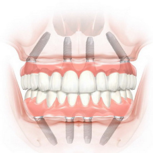 Имплантация зубов и протезирование All-on-4®